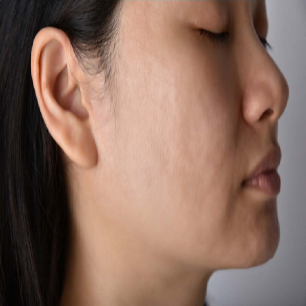 Subcision Treatment for Acne Scars 95
