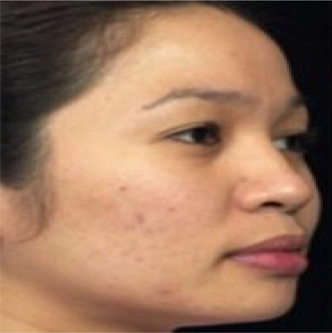 Subcision Treatment for Acne Scars 96
