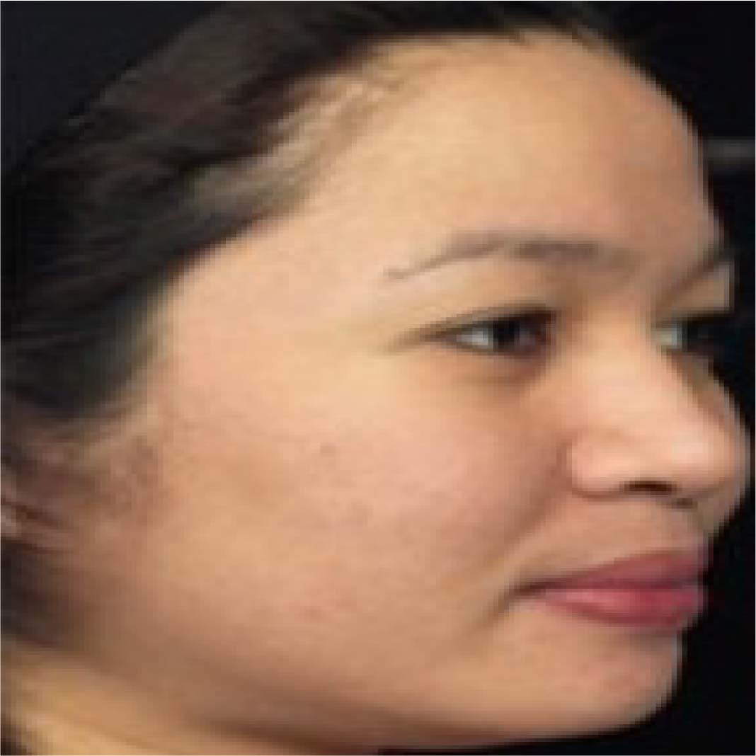 Subcision Treatment for Acne Scars 97