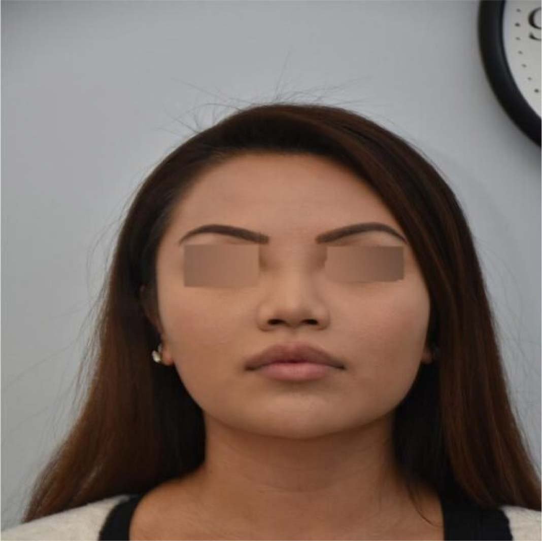 Expert Facial Contouring