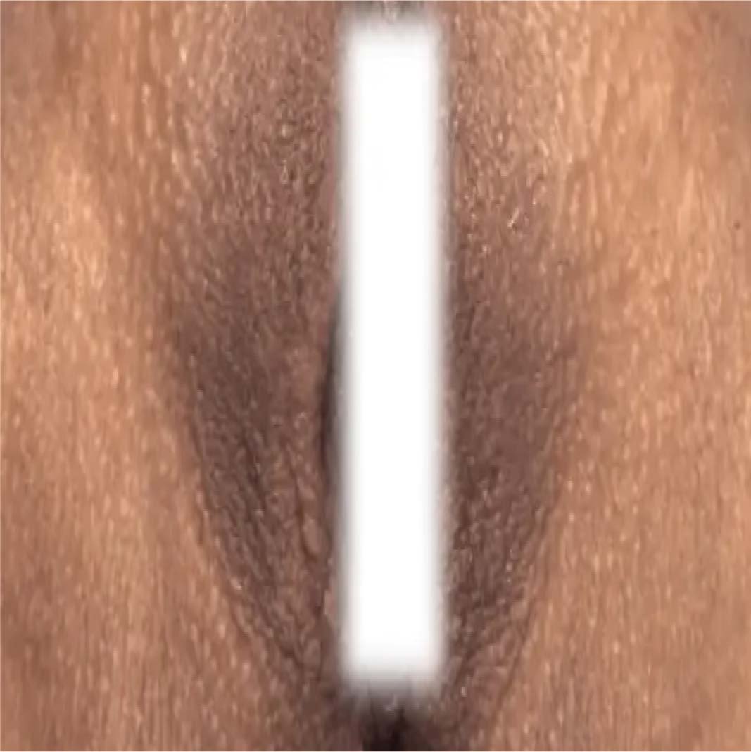 Dark Spot Removal Treatment