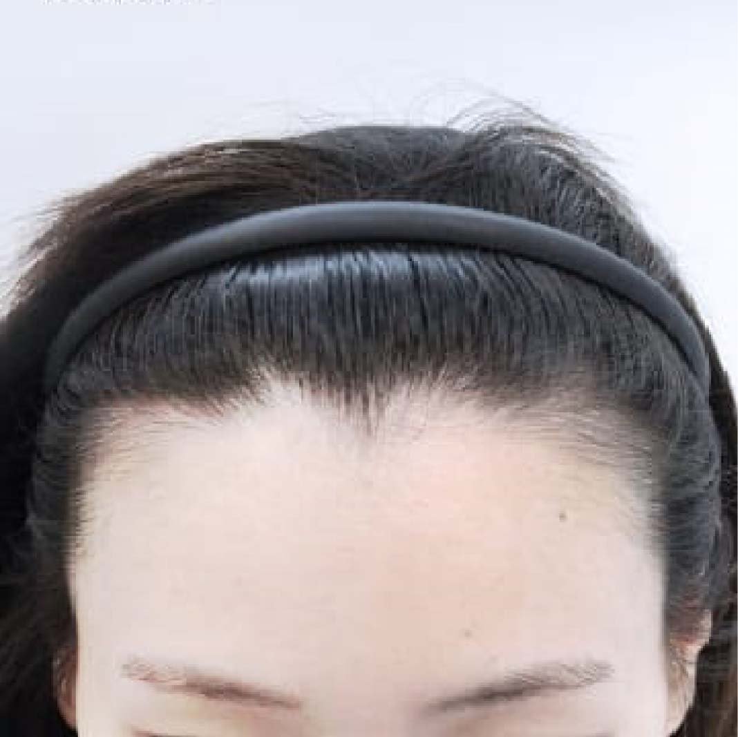 Hair Transplant in KL