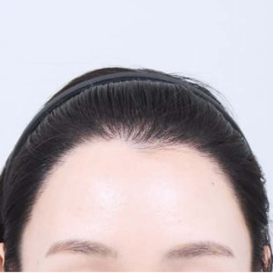 hair transplant before after 119