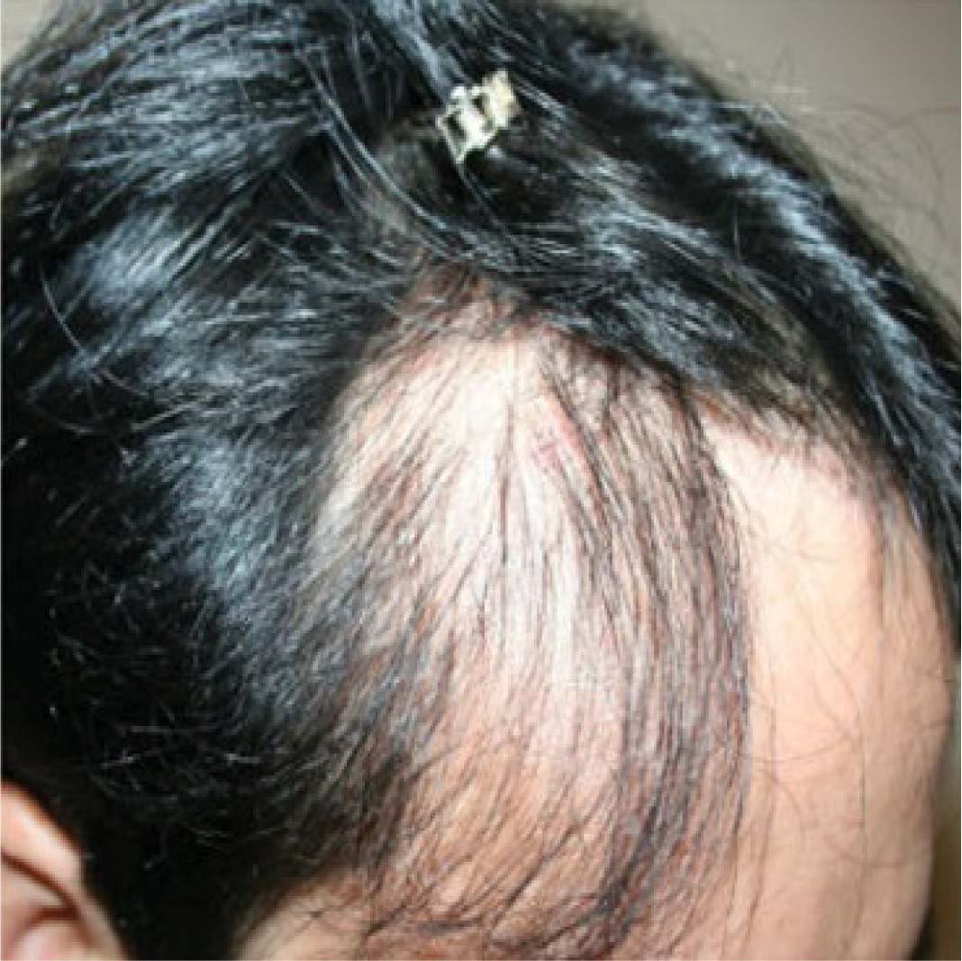 hair transplant before after 120