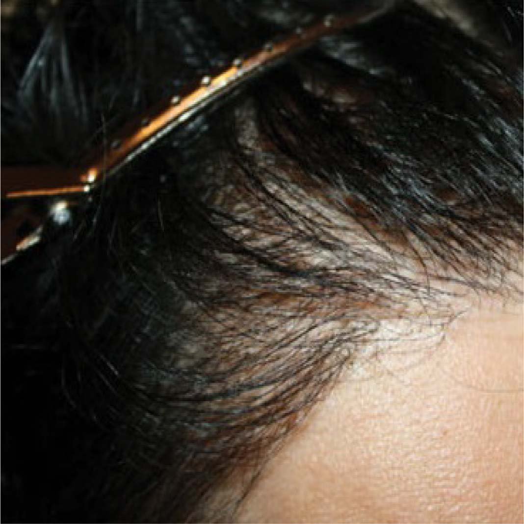 hair transplant before after 121