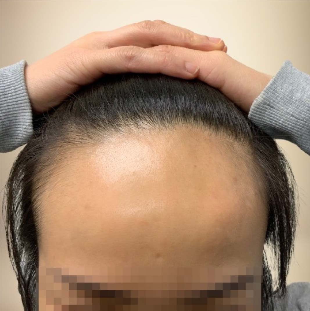 hair transplant before after 122