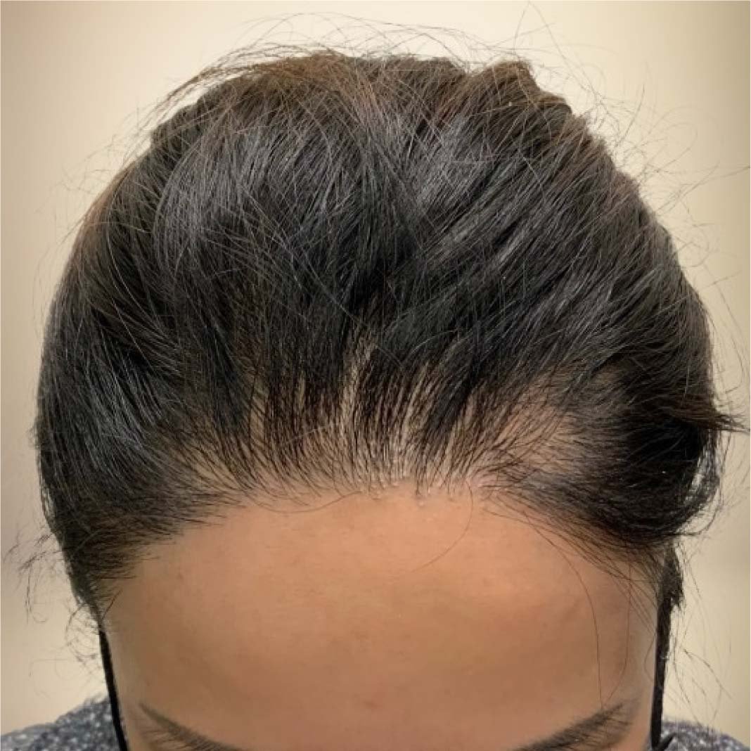 hair transplant before after 123