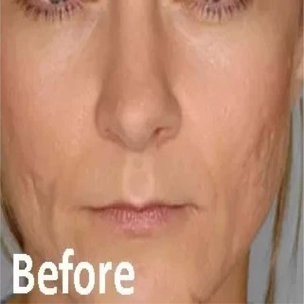 Neauvia Hydro Deluxe Injection Treatment