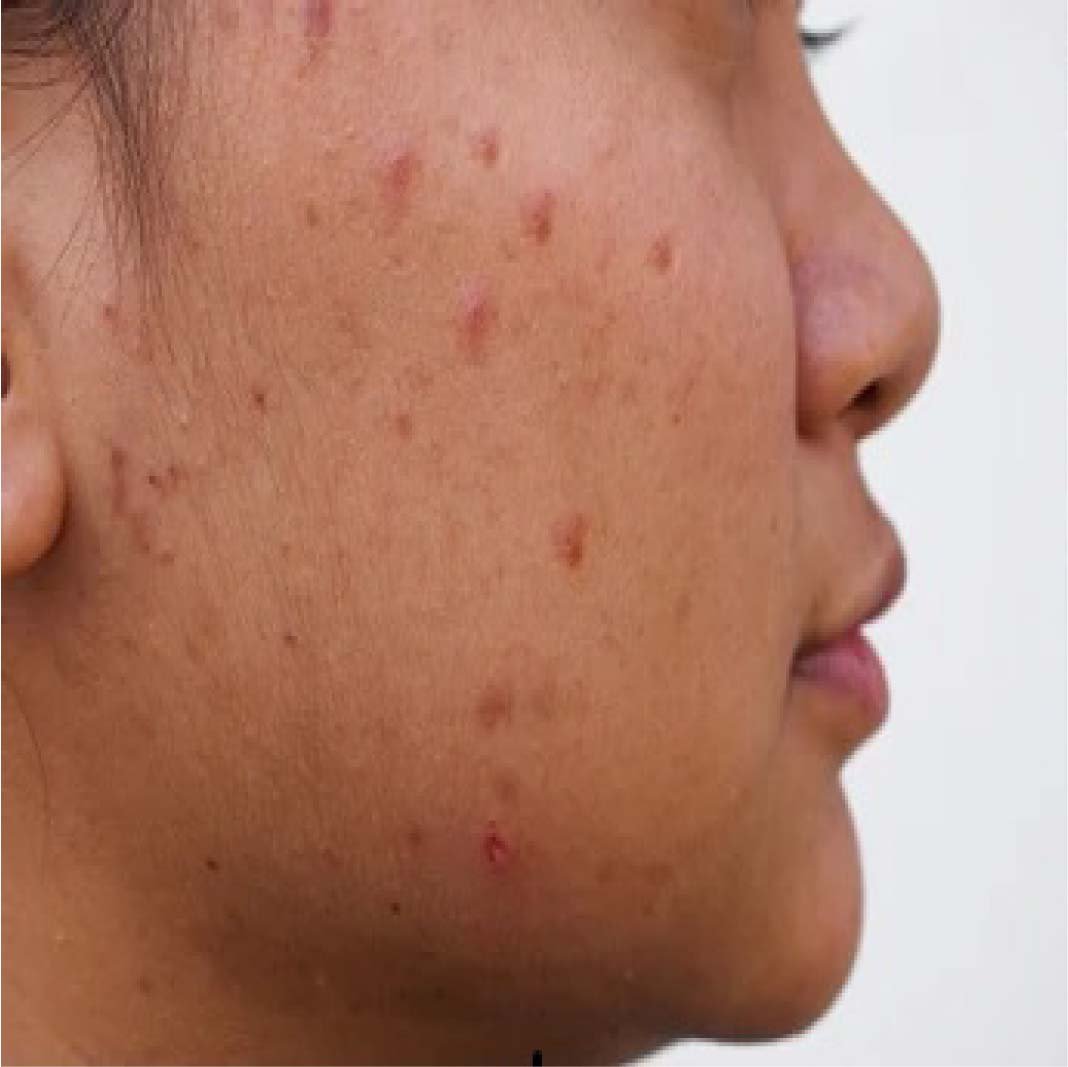 Transform Your Skin with Microdermabrasion