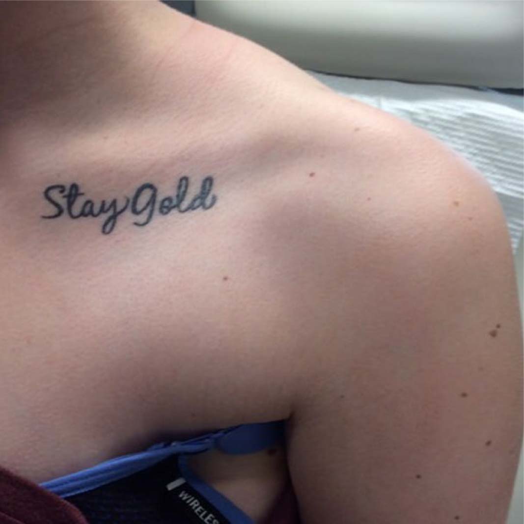 Tattoo Removal Kuala Lumpur