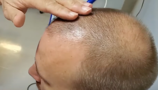 馬來西亞Nexus診所提供幹細胞療法治療掉髮