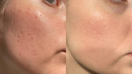 Nexus Clinic Karisma Collagen Skin Booster treatment for youthful skin.