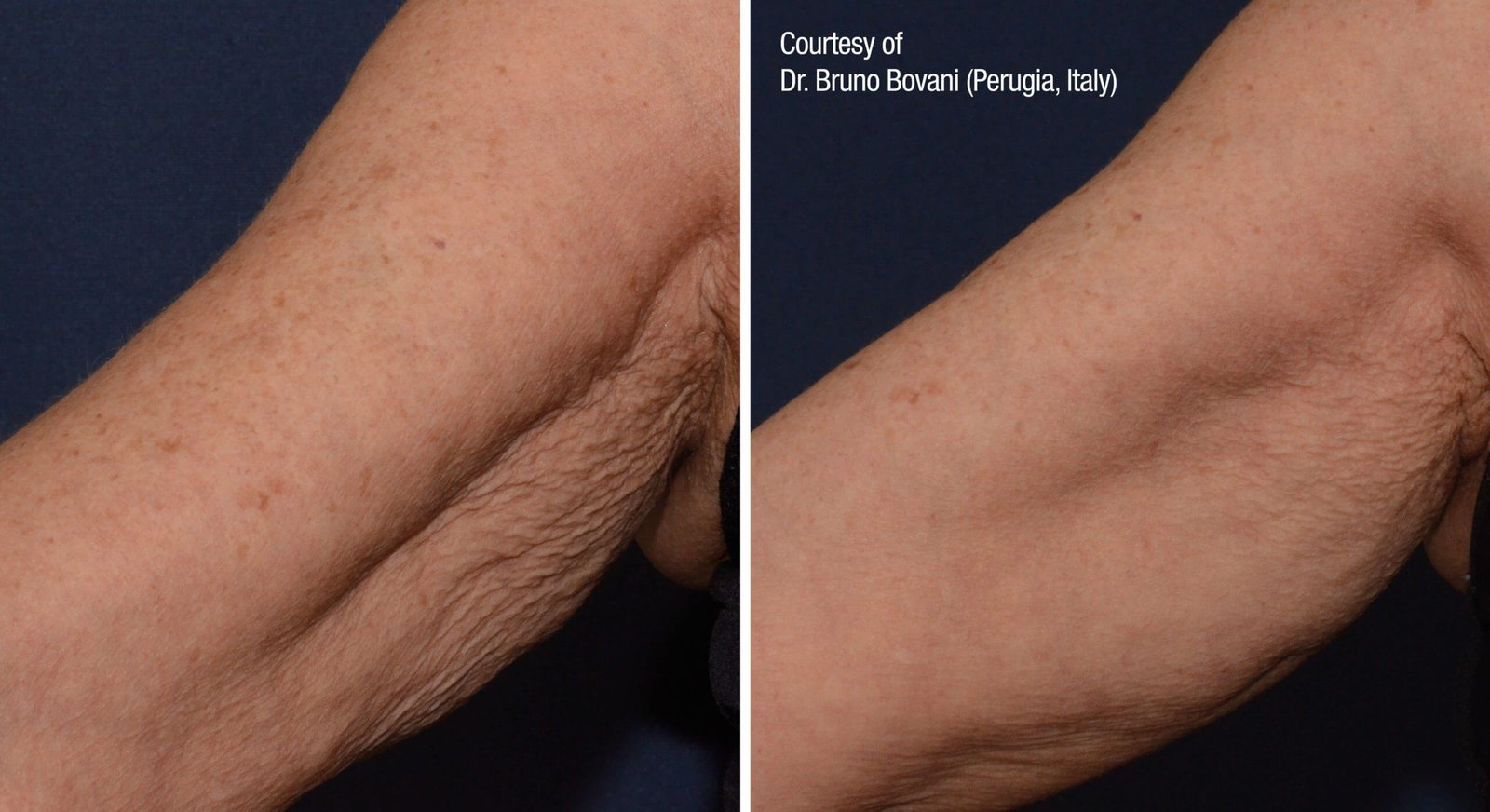 Inner-Arm-scaled Inner Arm scaled 1