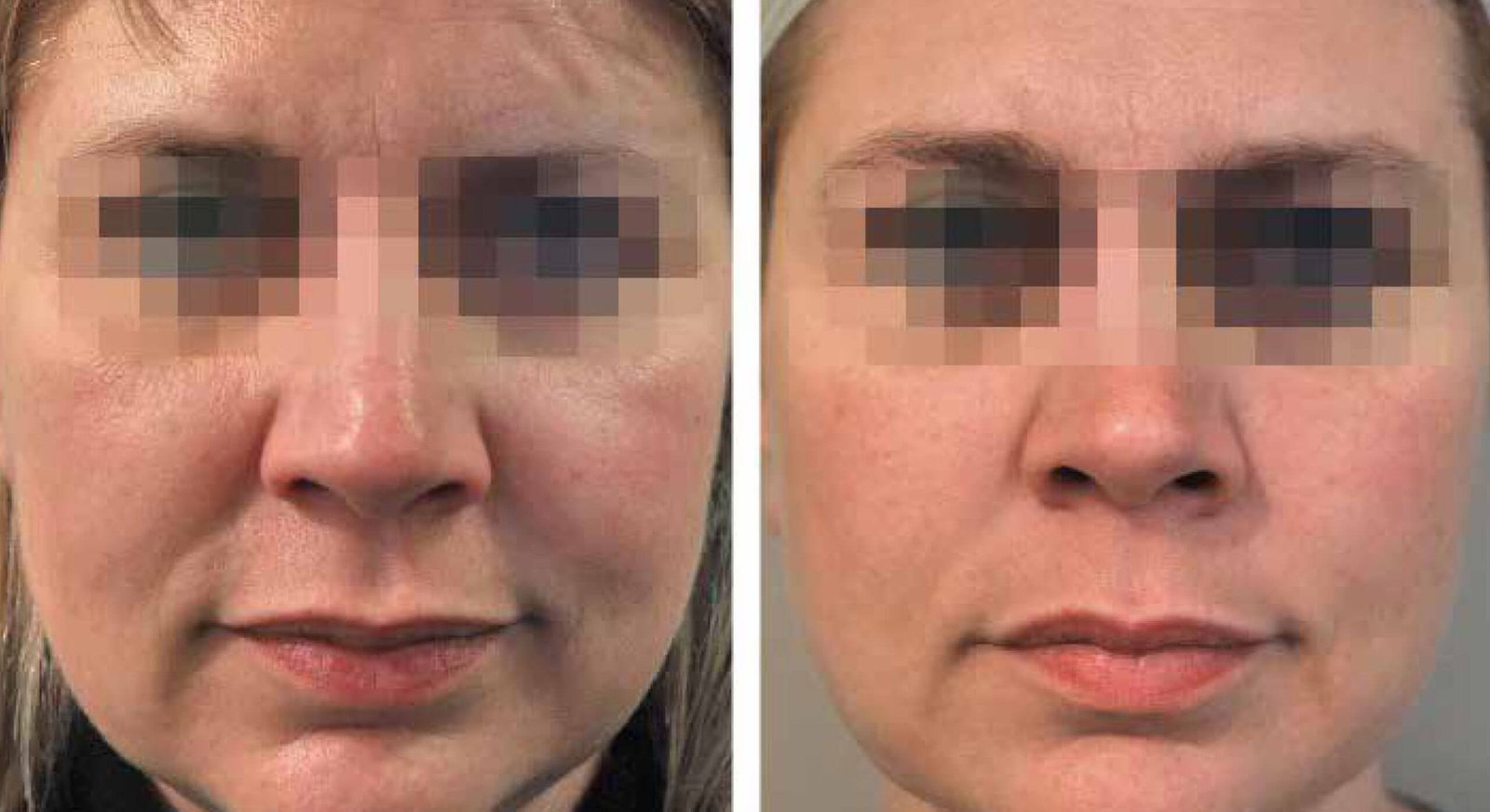 Malar-SubMentalv2-scaled Malar SubMentalv2 scaled 1