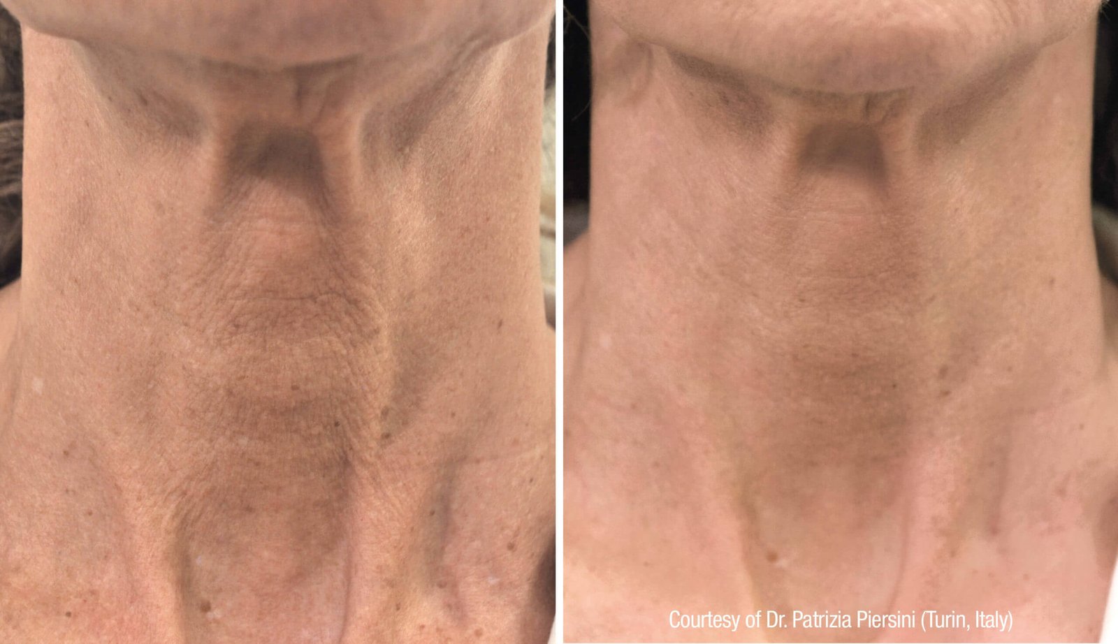 Neck-scaled Neck scaled 1