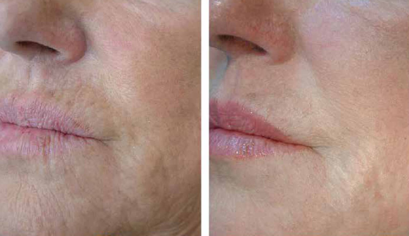 Perioralv2-scaled Perioralv2 scaled 1