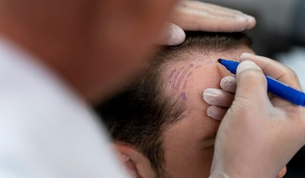 التصبغ الدقيق لفروة الرأس KL