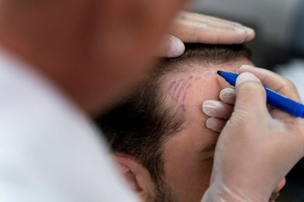 Scalp Micropigmentation KL