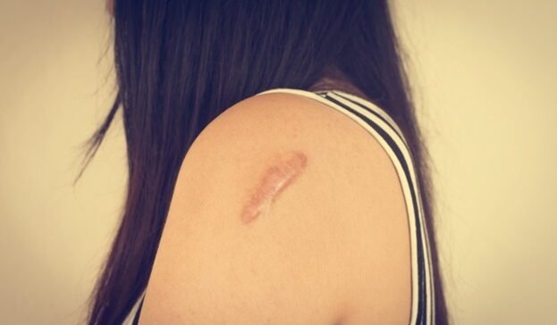 Scar treatment Malaysia