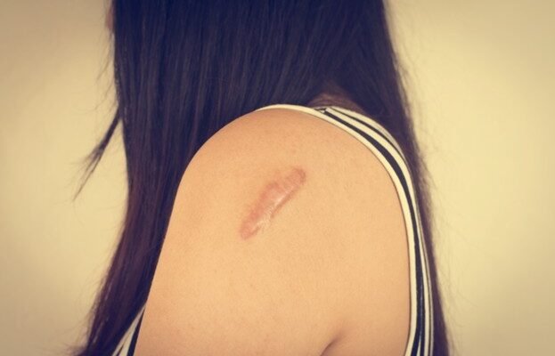 Scar treatment Malaysia