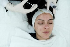 Acne scar treatment