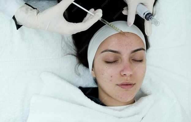 Acne scar treatment